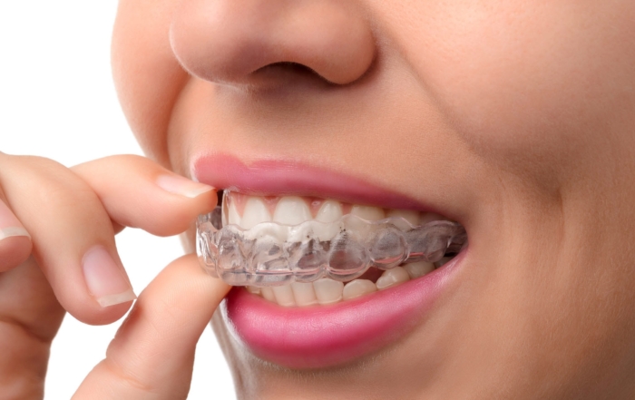Dental Splints: Key Benefits For Your Oral Health Highland Kitchener Dentist