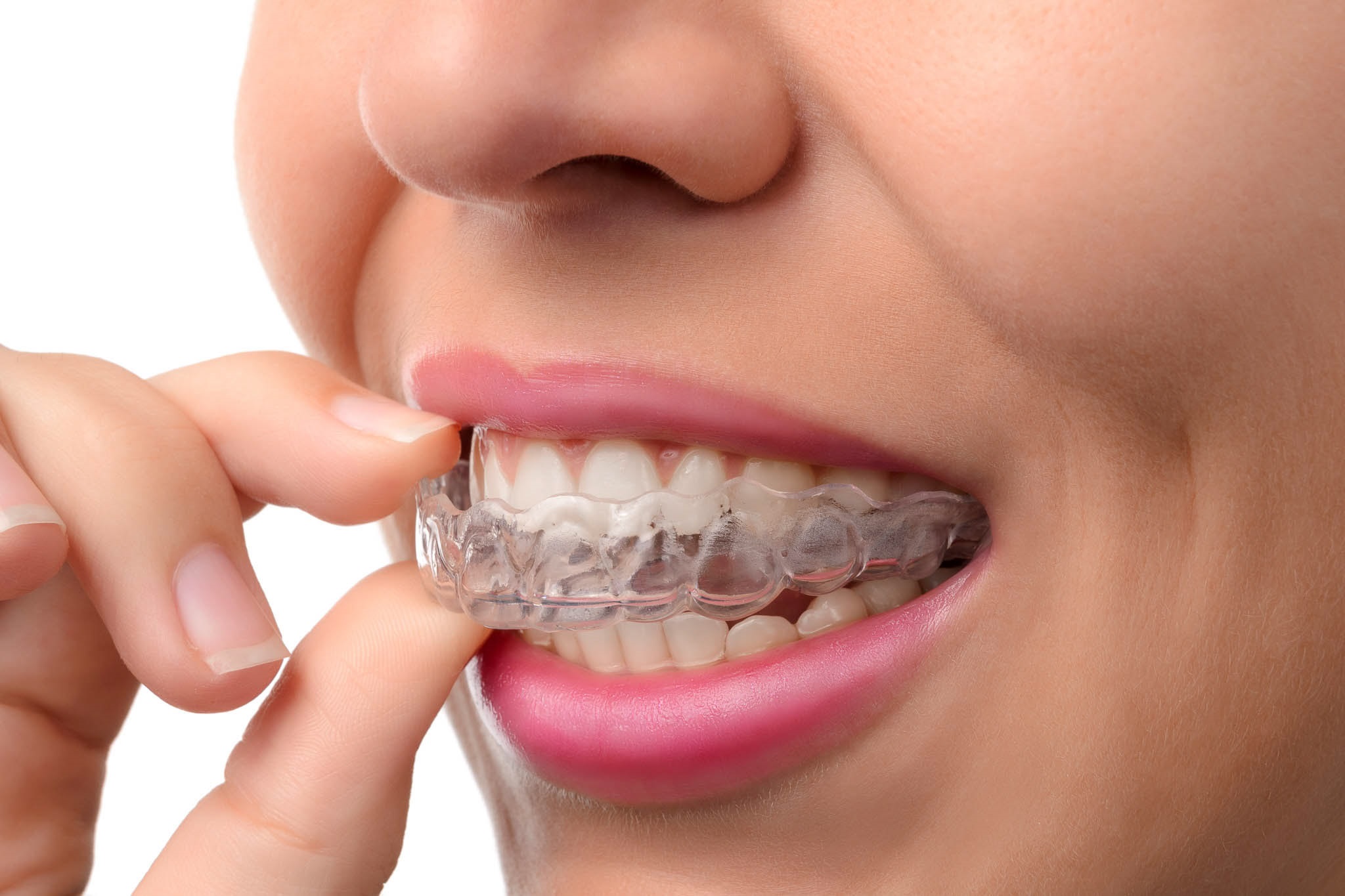 The Benefits Of Braces: A Path To A Healthy Smile Highland Kitchener Dentist